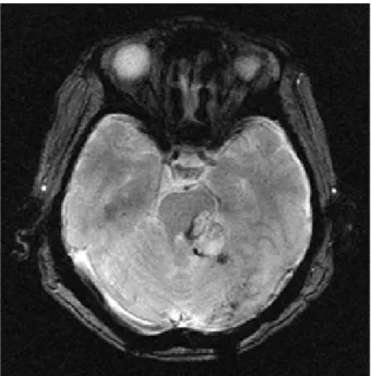 Figure 2. Frequent sharp-and-slow  waves are observed in the left  oc-cipital area (A)