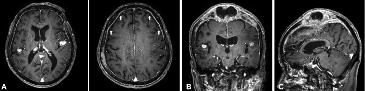Fig. 1. Brain computed tomography scans and skull X-ray showed osteolytic metastasis at vertex and both parietal high-convexities.