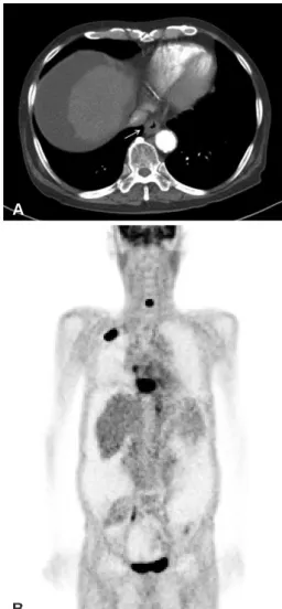 Fig. 3. CT and Positron emission tomography (PET) scans show 