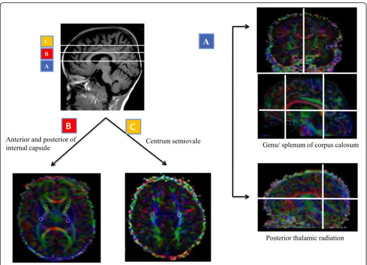 Fig. 1 A region-of-interest placement of the white matter tract selected on a representative infant diffusion tensor imaging at near-term age