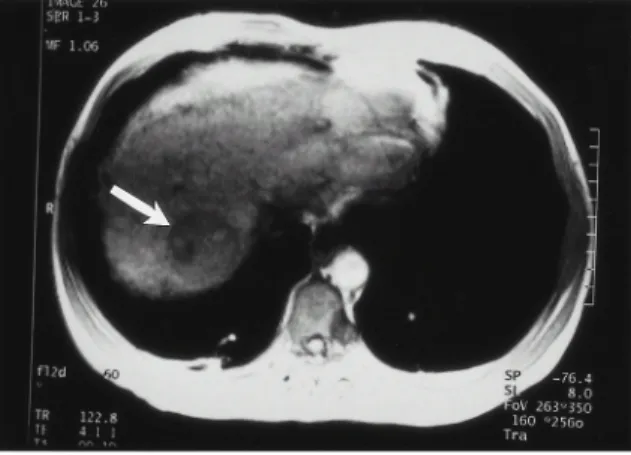 Figure 1. MRI finding of the abdomen shows 3×3cm sized round mass which has low signal density in T1WI in segment 7 and 8.