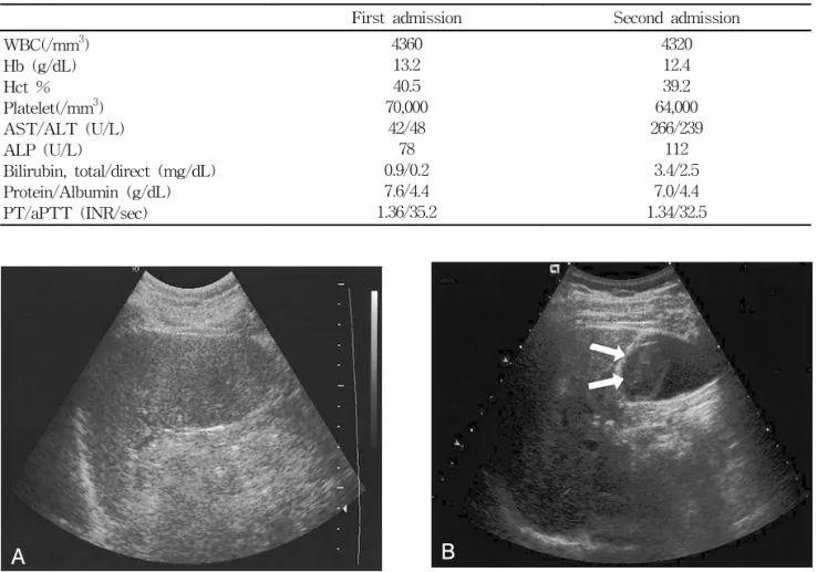 Figure  1.  Abdominal  ultrasonography.  Normal  looking  gallbladder  at  the  first  admission  (A)  and  high  echogenecity,  round  lesion  in  the  gallbladder  lumen(arrow)  at  the  second  admission  (B).