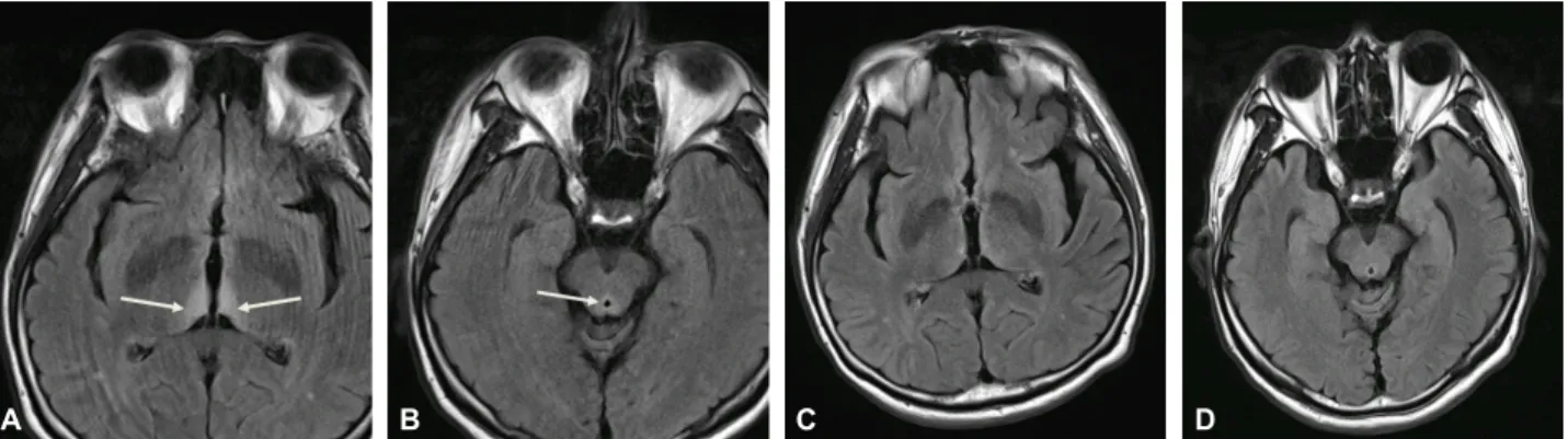 Figure 1. Coronal fluid attenuated inversion recovery (FLAIR) MR images. These FLAIR images show signal intensity alter- alter-ations of medial thalamus (white arrows, A) and periaqueductal area of the midbrain (white arrow, B) in an acute period  of disea