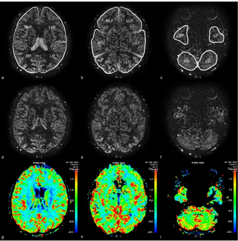 Fig 2. 12 areas of bilateral cerebral and cerebellar hemispheres. Brain MRI of a 76-year-old woman with dizziness