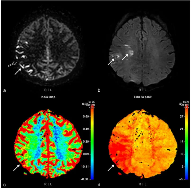 Fig 3. Arterial spin labeling (ASL) rank III perfusion abnormality. MRI of the brain of a 48-year-old woman with left-side motor weakness