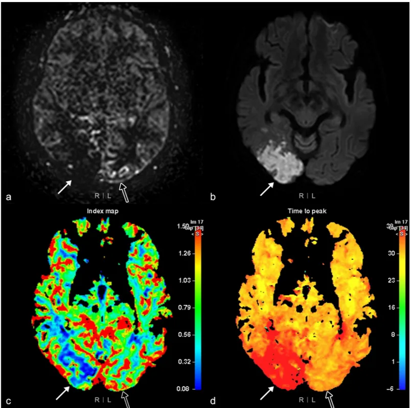 Fig 4. Arterial spin labeling (ASL) rank II and IV perfusion abnormalities. MRI of the brain of a 78-year-old woman with a left visual field defect