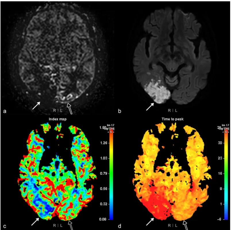 Fig 4. Arterial spin labeling (ASL) rank II and IV perfusion abnormalities. MRI of the brain of a 78-year-old woman with a left visual field defect