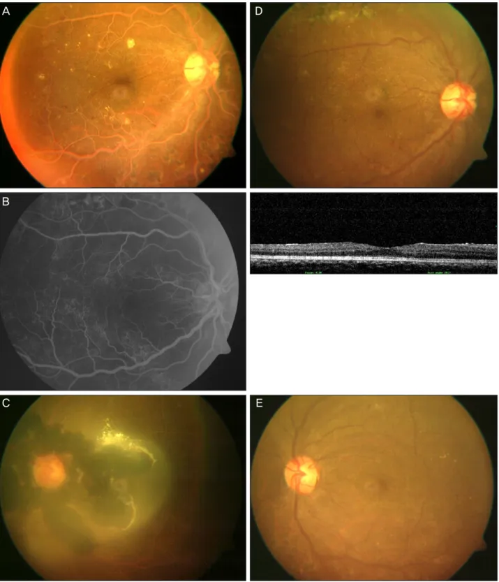 Figure 2. Fundus photography, fluorescein angiogram and optical coherence tomography before (A, B, C) and after (D, E) reso- reso-lution of elevated triglyceride