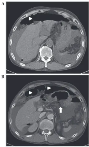 Figure 1. Computed tomography (CT) scans of the abdomen. (A) CT scan  revealed pneumoperitoneum (arrowheads), fluid collection of abdomen and  shrinkage of the liver
