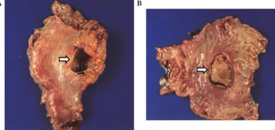 Figure 2. A gross surgical specimen from the gastrectomy shows a large defect of the stomach (arrows)