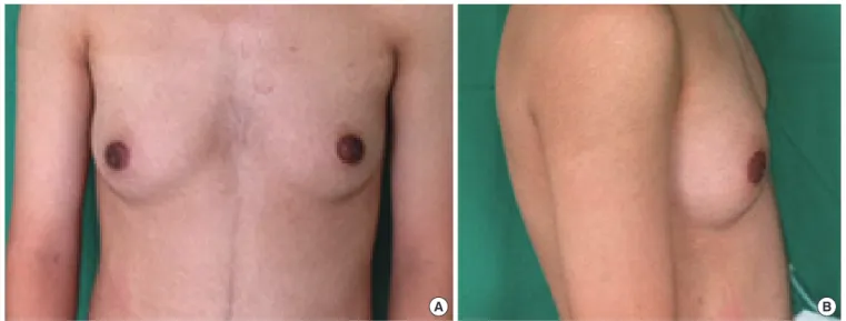 Fig. 2.  External genitalia, micropenis. 