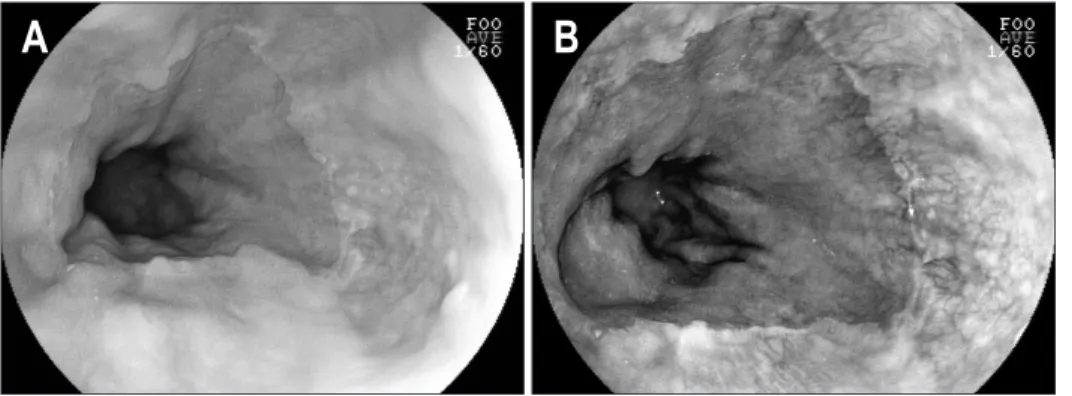 Fig. 1. (A) A still image obtained  using conventional endoscopy in a  patient without erosive esophagitis