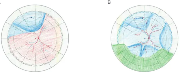 Fig. 1. Fundus drawings of the primary scenario (A) and the second scenario (B) presented in the questionnaire.