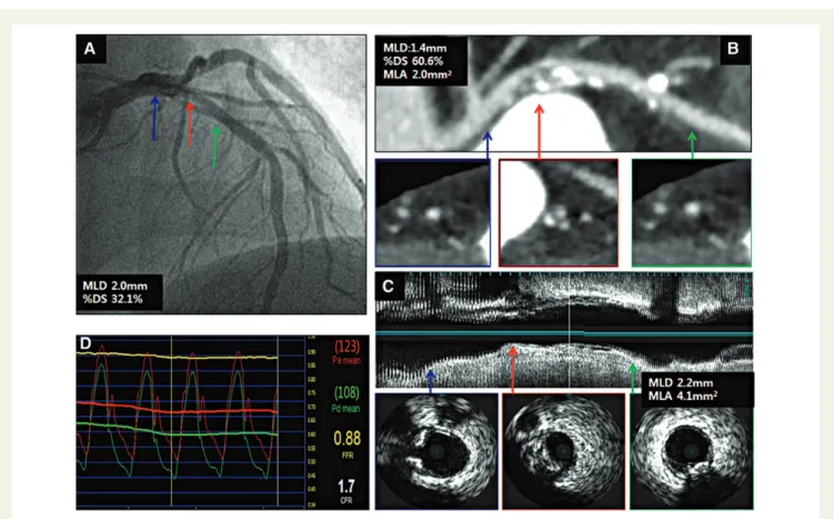 Figure 1 A representative case demonstrating ICA (A), CCTA (B), IVUS (C ), and FFR (D) assessment for the stenosis located in the proximal left