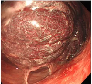 Figure 1. Endoscopic picture: A bulky, rounded con- con-gestive mass is seen in the stomach and the  adja-cent gastric mucosa is petechial changed.