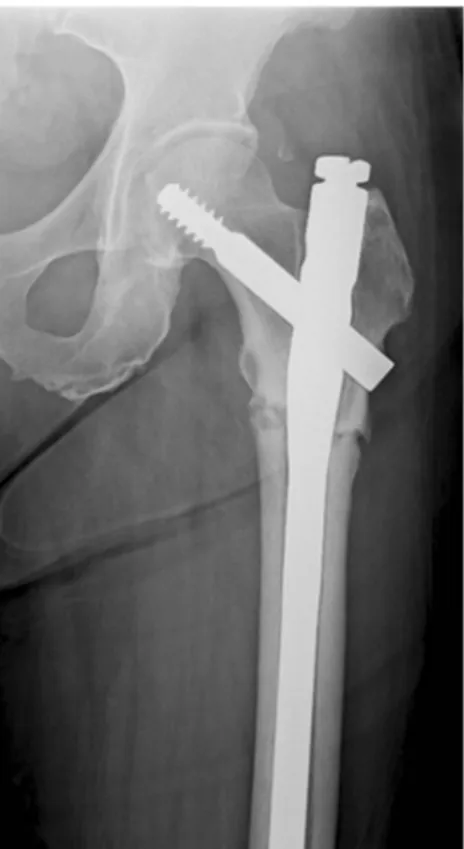 Fig. 4 At six months after operation, delayed union of fracture was noticed. Parathyroid hormone (PTH) was administered subcutaneously for four months