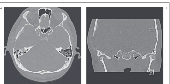 Figure 1  A) Axial temporal bone computed tomography (CT) scan shows bony destruction of the anterior portion of the  mastoid air cells resulting in the meniscus sign