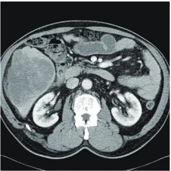 Fig. 2. The cut section shows a large variegated solid and firm  mass, composed of a grey-to-yellow solid area and a dark red  hemorrhagic area