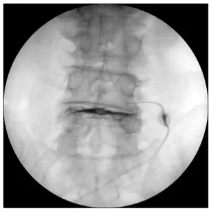 Fig. 1. Anteroposteroior fluoroscopic image showing intra- intra-discal dye spread.