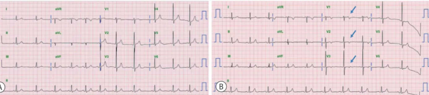 Figure 1 . (A) Baseline electrocardiogram (ECG) obtained 2 months before symptom onset showing a normal sinus rhythm