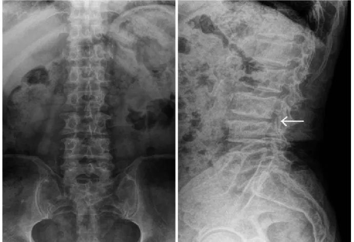 Fig. 2. Plain radiograph shows narrowing of the disc space at L3-L4 level. Destruction of the superior endplate of the L4 vertebra, and the 