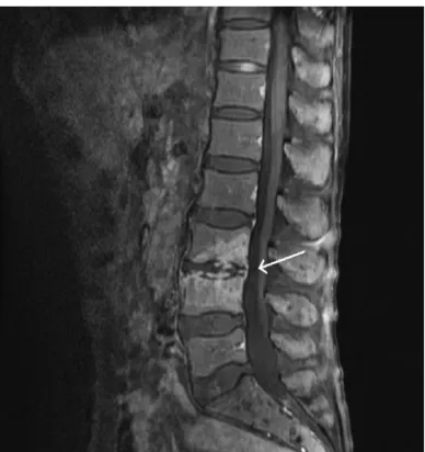 Fig. 3. Spine MRI shows abnormal high signal density in the disc 