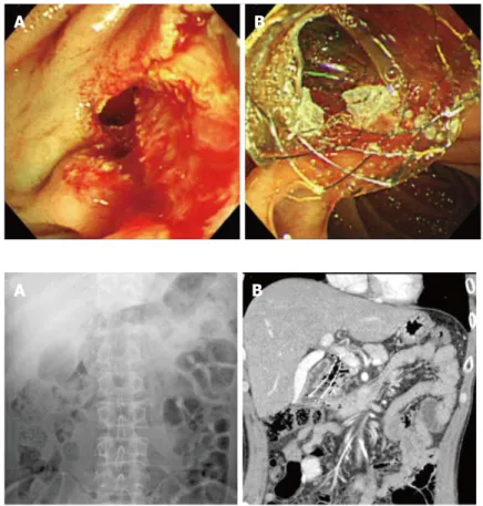 Figure 1  Insertion of fully covered self-expandable metal- metal-lic stent for the management of periampullary perforation  immediately after endoscopic sphincterotomy