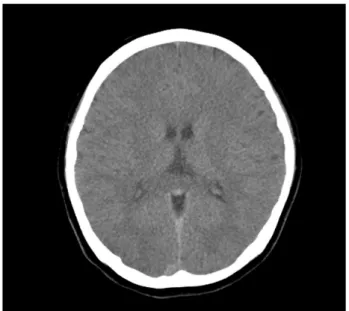 Fig. 3 . The findings of brain computed tomography.  Brain com- com-puted tomography on hospitalized day 2 showed an attenuation  of lobar gray-white matter differentiation.