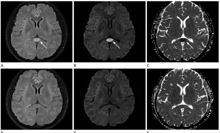 Fig. 1. MR images from a 38-year-old woman who ingested glufosinate ammonium-containing herbicide in a suicide attempt
