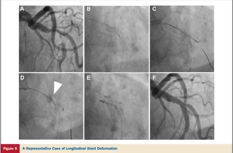 Figure 5 A Representative Case of Longitudinal Stent Deformation