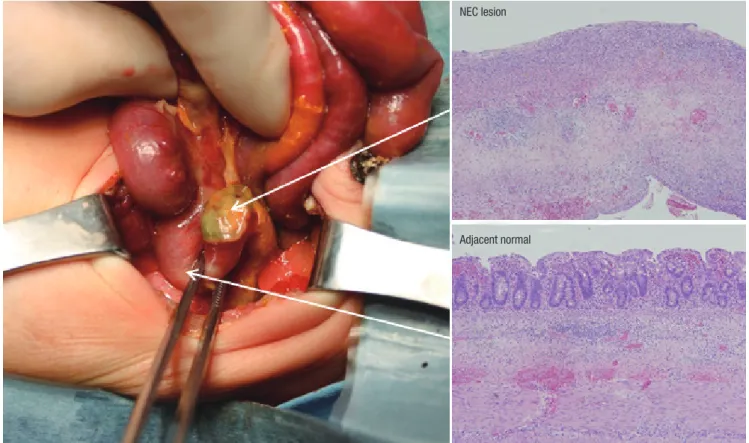 Fig. 1. NEC tissues for experiment and histological features. Arrows indicate 2 tissue sections (NEC lesion and adjacent normal regions) from the resected small bowel segment  and each histological examination.