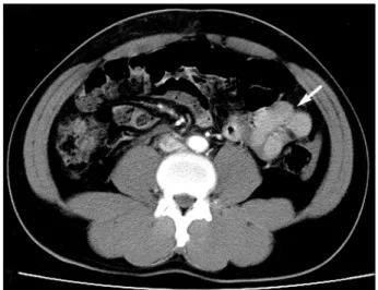 Fig.  1.  Postcontrast  CT  scan  performed  on  the  day  of  the  traffic  accident  shows  minimal  hemoperitoneum  and  small  bowel  wall  thickness  and  mesenteric  haziness  in  the  left  lower  abdomen.