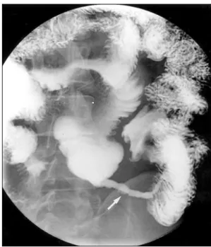 Fig.  2.  Simple  abdominal  X-ray  represent  distended  intestinal  loops  and  air  fluid  level
