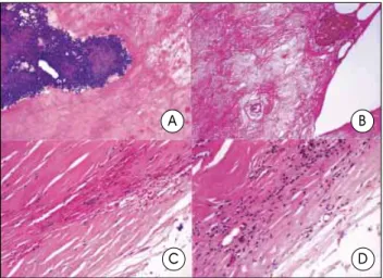 Fig. 1. Plain skull film (A) showing a very large, round calcification in the left frontotemporal region and thickening of the overlying cranium