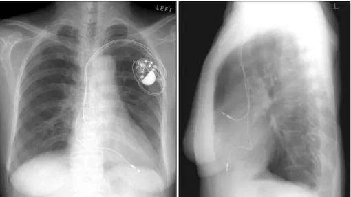 Fig. 1. Chest X-ray in the posteroanterior and left lateral projection. Both show the exact location of the atrial and ventricular leads, which are located in the right atrial appendage and right ventricular apex, respectively