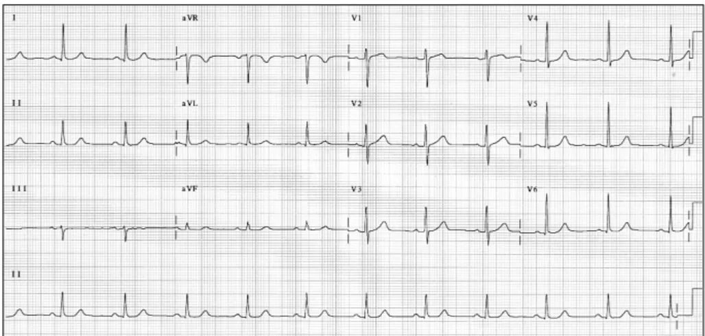 Fig. 1. Electrocardiogram showed no ST-T wave abnormalities. 