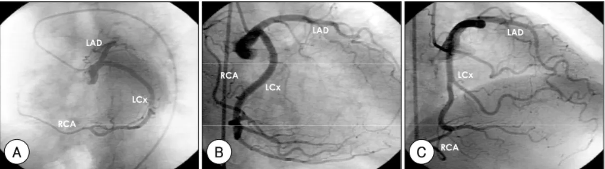 Fig. 3. A：left anterior oblique caudal view of left coronary system showed single coronary artery arises from the left corornary sinus and right coronary artery originate from distal left circumflex artery