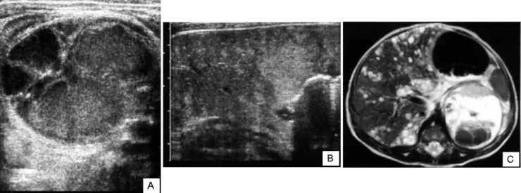 Fig. 2. Light microscopy of the adrenal gland. Undifferentiated small tumor cells with round hyperchromatic nuclei are  prolif-erated in the adrenal parenchymal portion(H&amp;E, ×400).
