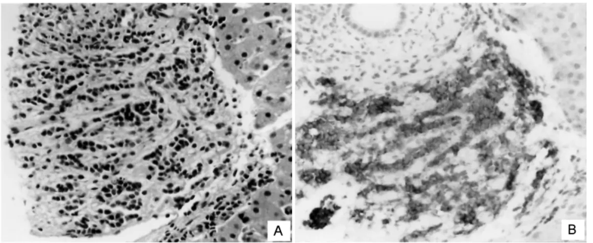 Fig. 3. Light microscopy of the liver tissue. (A) The undifferentiated tumor cells are metastasized into the portal area of the liver tissue(H&amp;E, ×400)