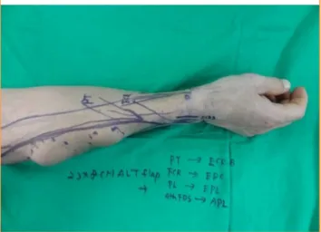Fig. 1. Preoperative design of resection and tendon transfer