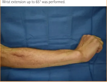 Fig. 5. Fist motion at postoperative 22 months  Fig. 7. Wrist extension at postoperative 22 months 