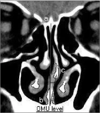 Fig. 1. Measurement of nasal septal deviation angle (∠ABC) at nasal valve level (window setting W250, L50)-point A is presenting crista galli, B is anterior nasal spine and C is most deviated point of nasal septum
