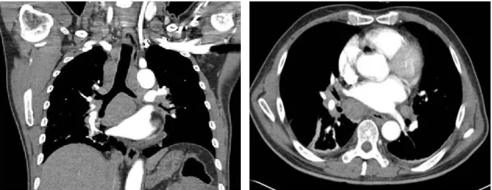 Figure 1. Contrast enhanced computed tomography of the chest showing markedly enlarged lymph nodes in bilateral supra- supra-clavicular fossa, mediastinum, hilar and interlobar areas