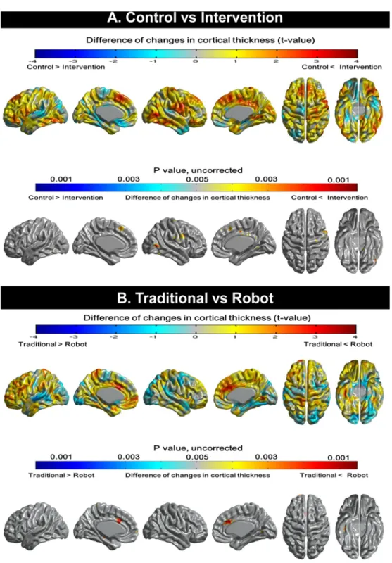 Fig 2. Topographical changes in cortical thickness. (A) Compared to the control group, the intervention group shows attenuated cortical thinning on heteromodal association cortices such as the bilateral medial prefrontal and right middle temporal gyrus