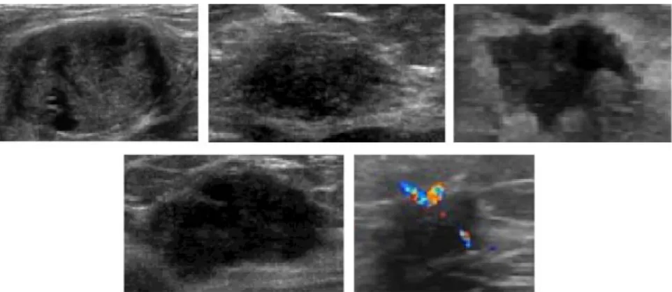 Fig. 4. Examples of (a) circumscribed; (b) indistinct; (c) angular; (d) microlobulated,   and (e) spiculated lesions in ultrasonography