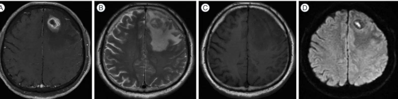 Fig. 1. Brain magnetic resonance imaging (MRI) shows heterogenous enhancing nodular lesion in left frontal lobe with adjacent edema (A)