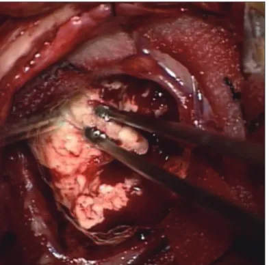 Fig. 2. Intraoperative photography demonstrates a white-yellowish and  hard mass with well-defined capsule