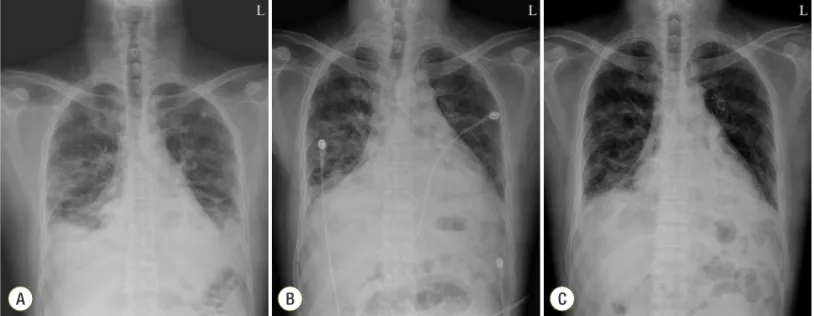 Fig. 1.  Chest X-ray. Chest X-ray on the day of admission, showing an ill-defined consolidation in both lower lobes and infiltration in the  peripheral lung in both middle lung fields (A)