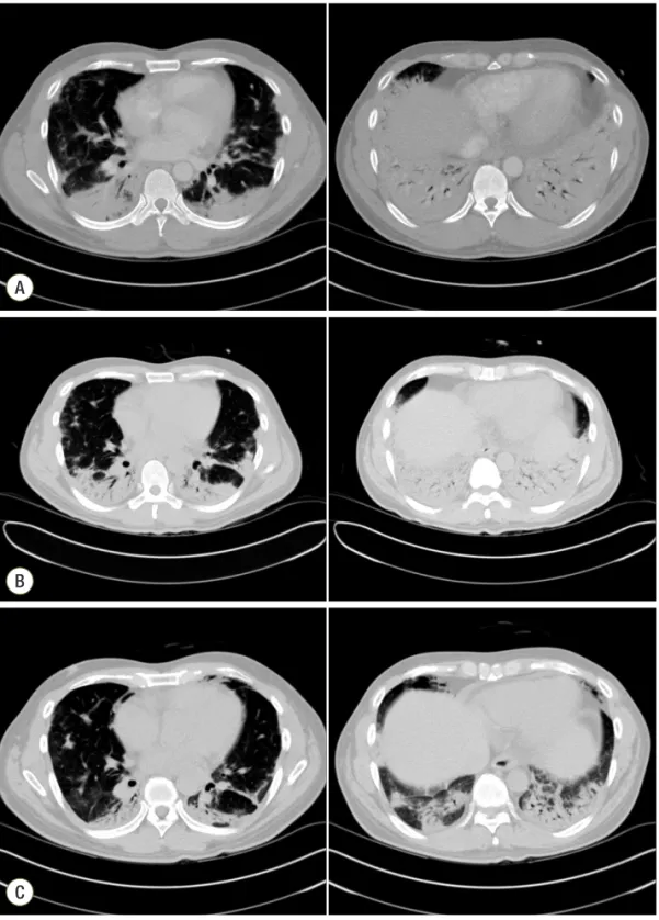 Fig. 2. Chest computed tomogra- tomogra-phy (CT). Chest CT at admission,  showing peripheral consolidations  in both lungs with ground-glass  opacity mainly in the dependent  portion (A)