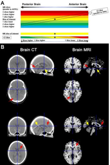 Figure 1.  Different slice angles for axial MR vs. CT images. (A) The anterior-posterior commissure line 